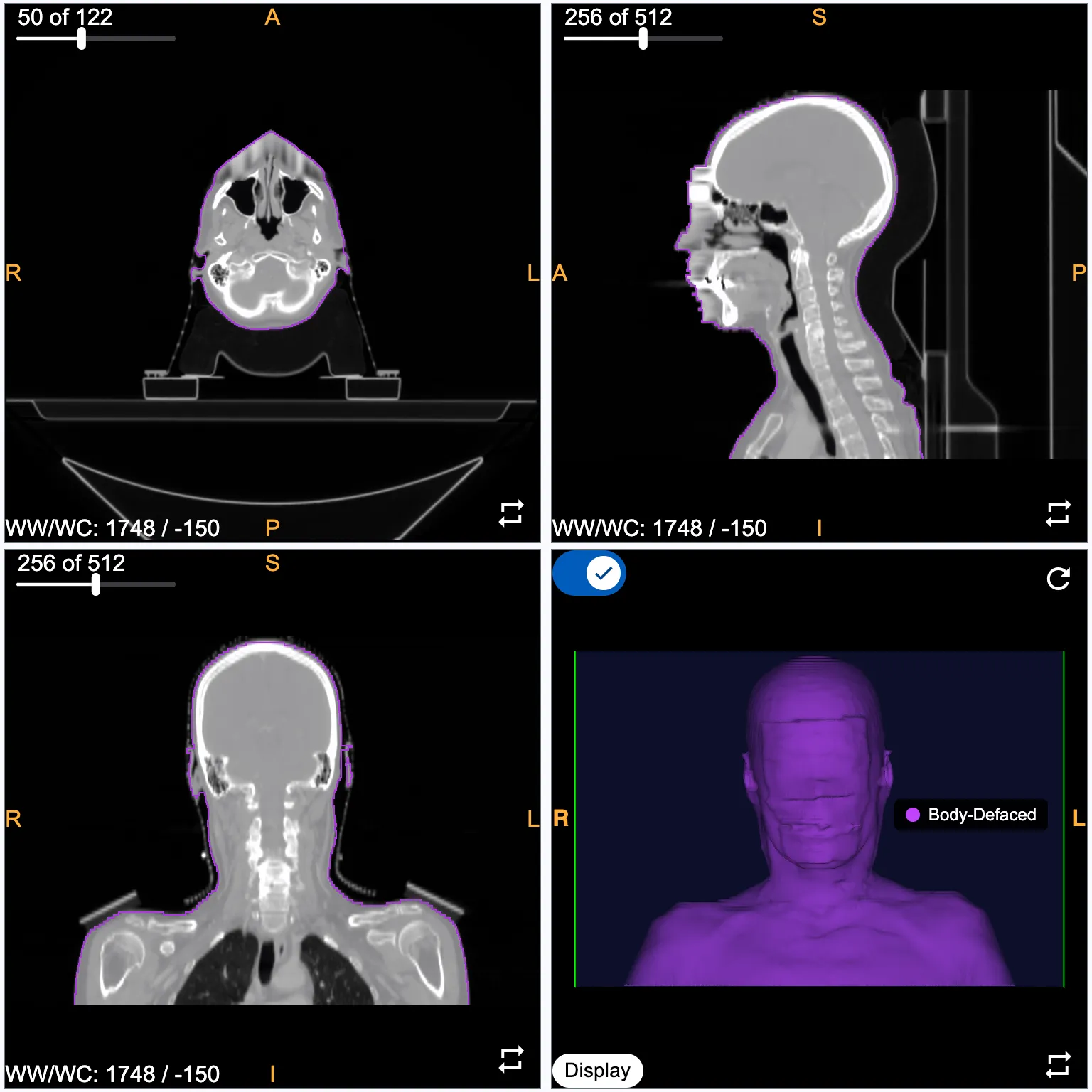 Same scan after mask-based defacing