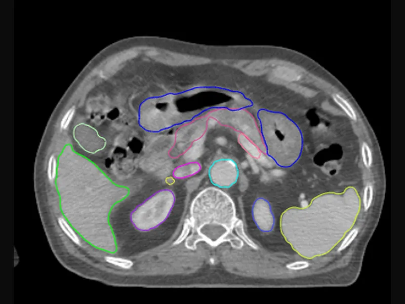 Abdomen-pelvis CT contour example with liver, kidneys, and bowel structures