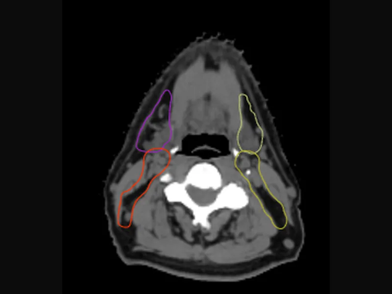 Head and neck OAR contouring example
