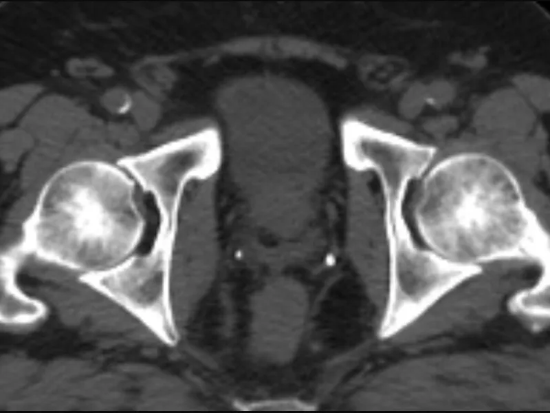 Axial CT slice of the pelvis with prostate, bladder, and rectum contoured