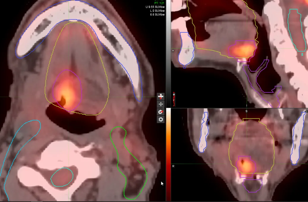 INTContour PET/CT contouring with target volume calculation