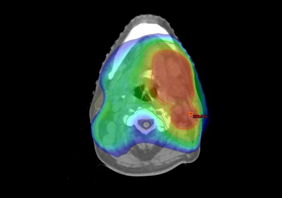 Independent Monte Carlo dose distribution overlaid on a CT slice