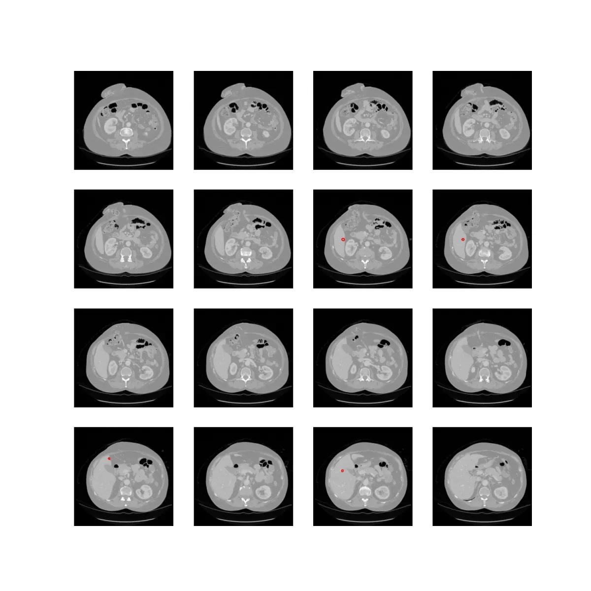OncoAI LiverTumor showing axial CT slices with segmented hepatic lesions