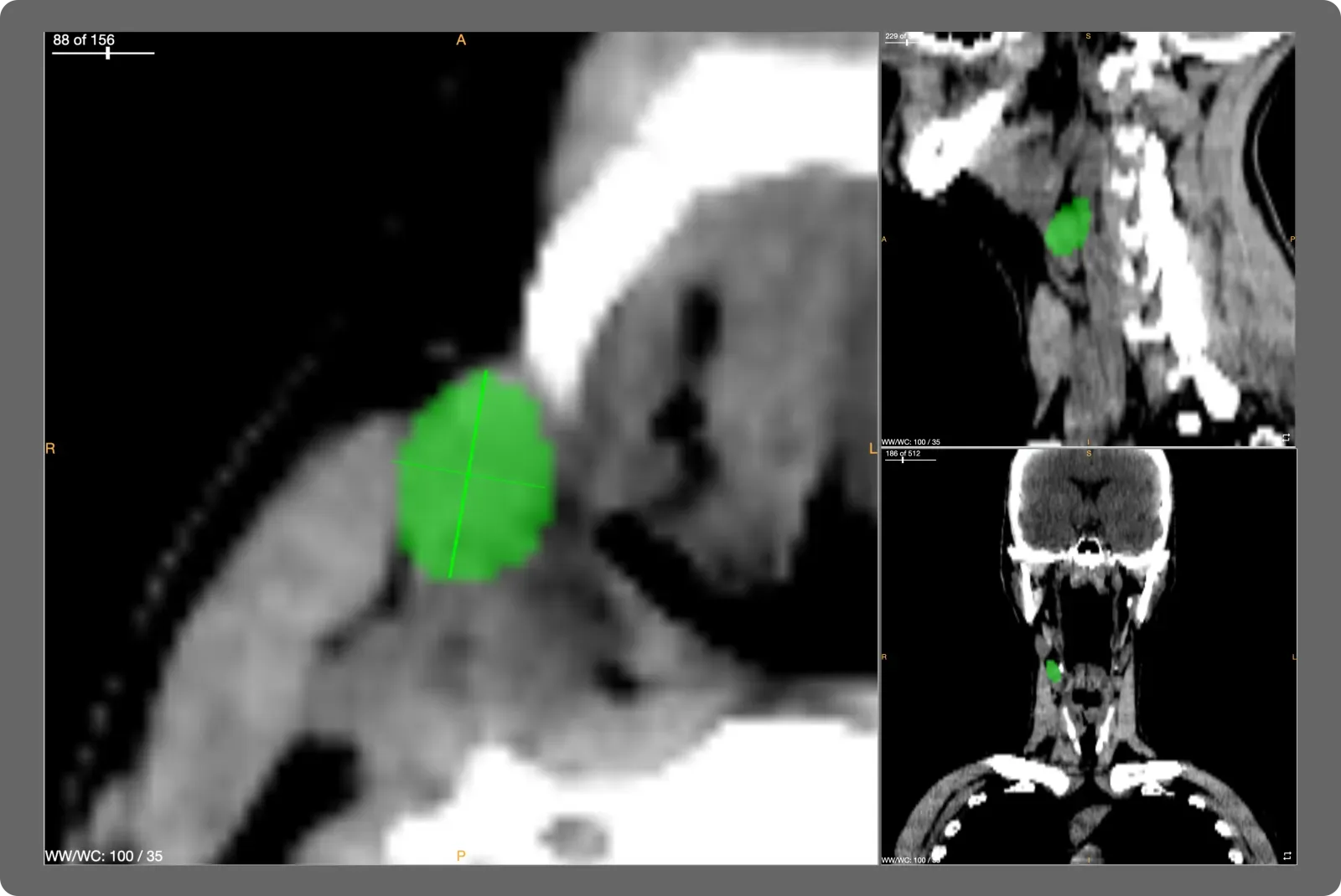 OncoAI LymphNode showing a segmented lymph node in axial, sagittal, and coronal views