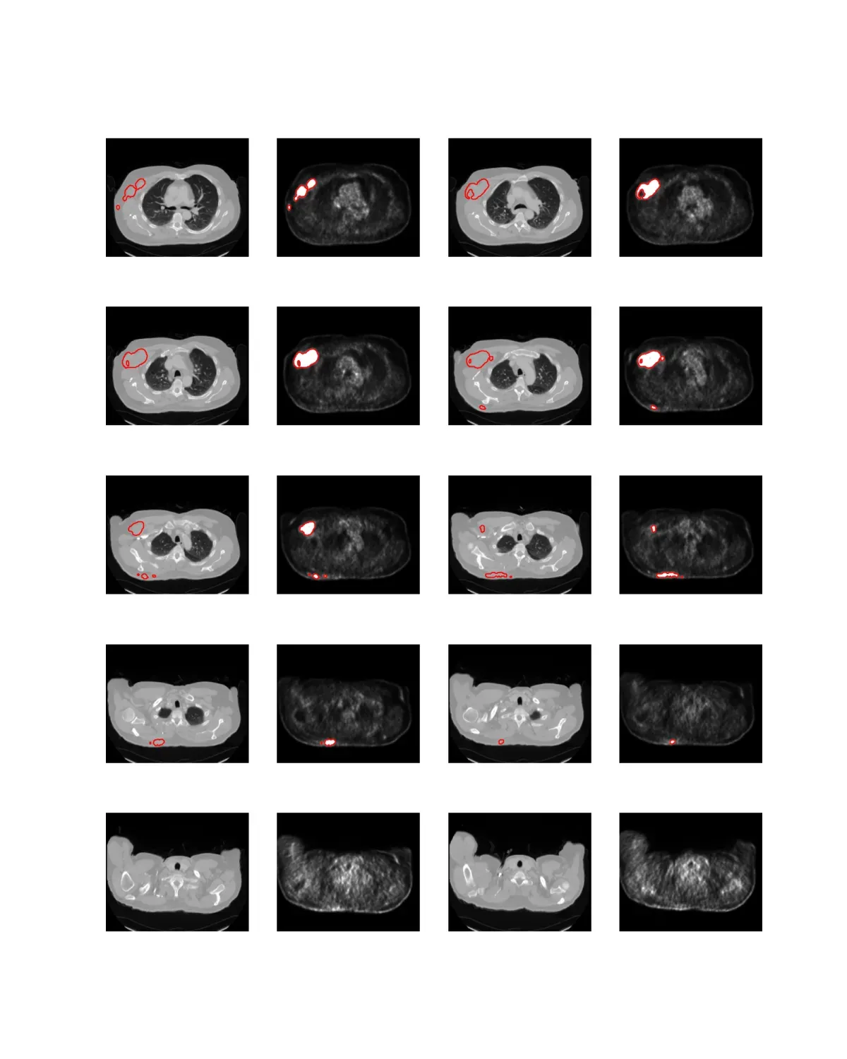 OncoAI PET/CT showing paired CT and PET axial slices with red lesion contours across multiple body levels