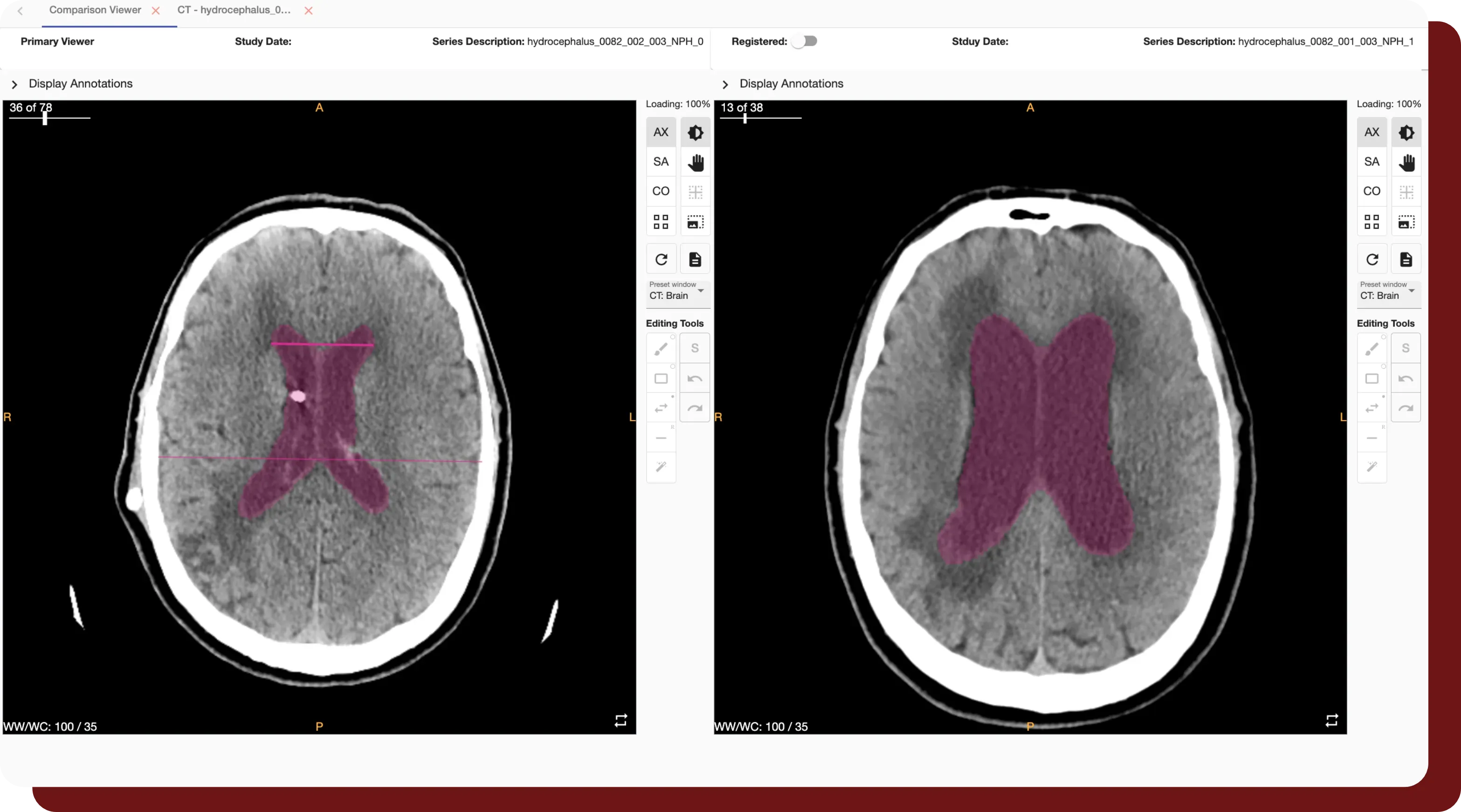 QuantBrain two-pane longitudinal comparison view — baseline left, follow-up right — with ventricle segmentations on both timepoints
