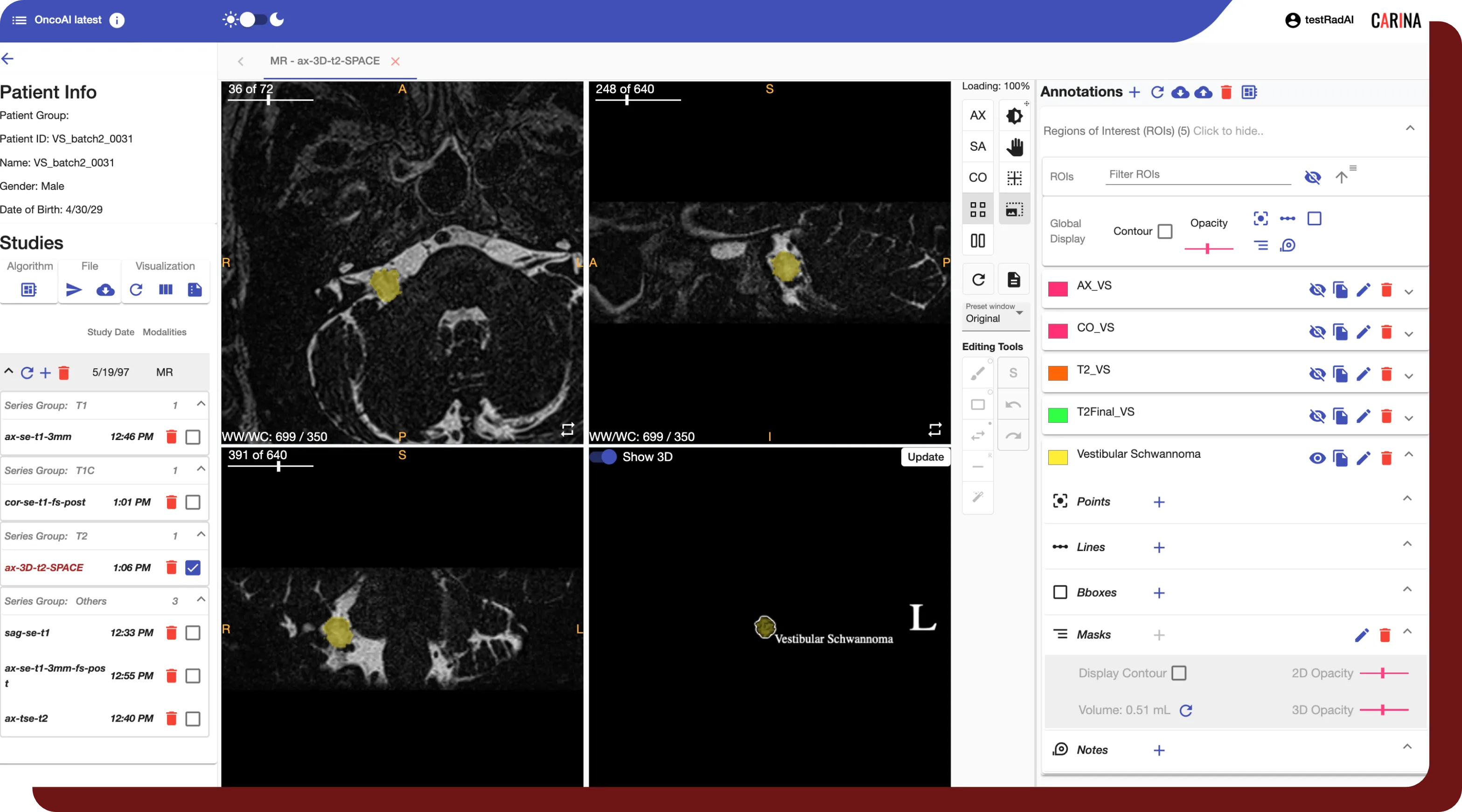 An example study that has been automatically segmented and viewed in OncoAI - BrainTumor's built-in viewer.