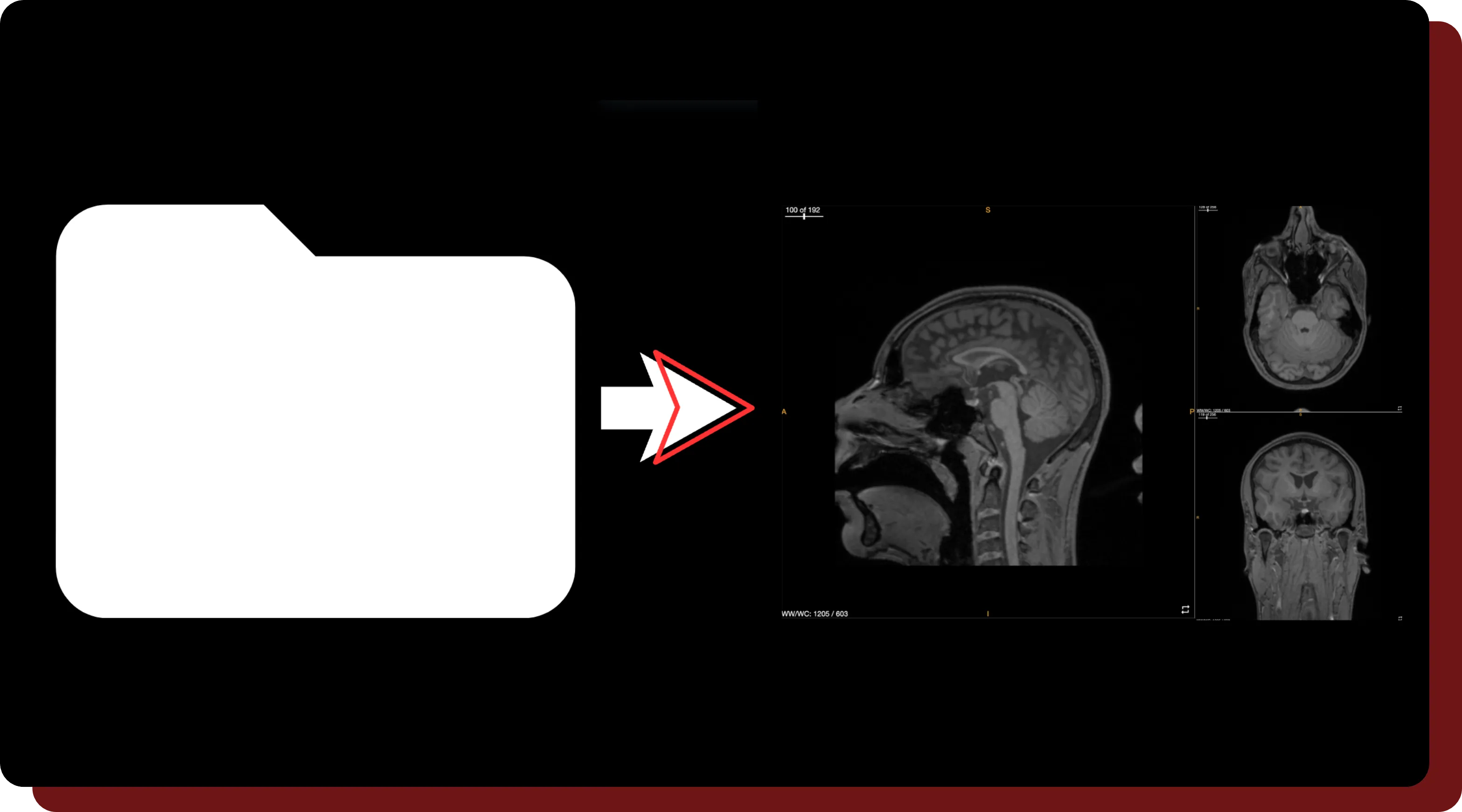 An figure illustrating the parsing feature in OncoAI - BrainTumor.