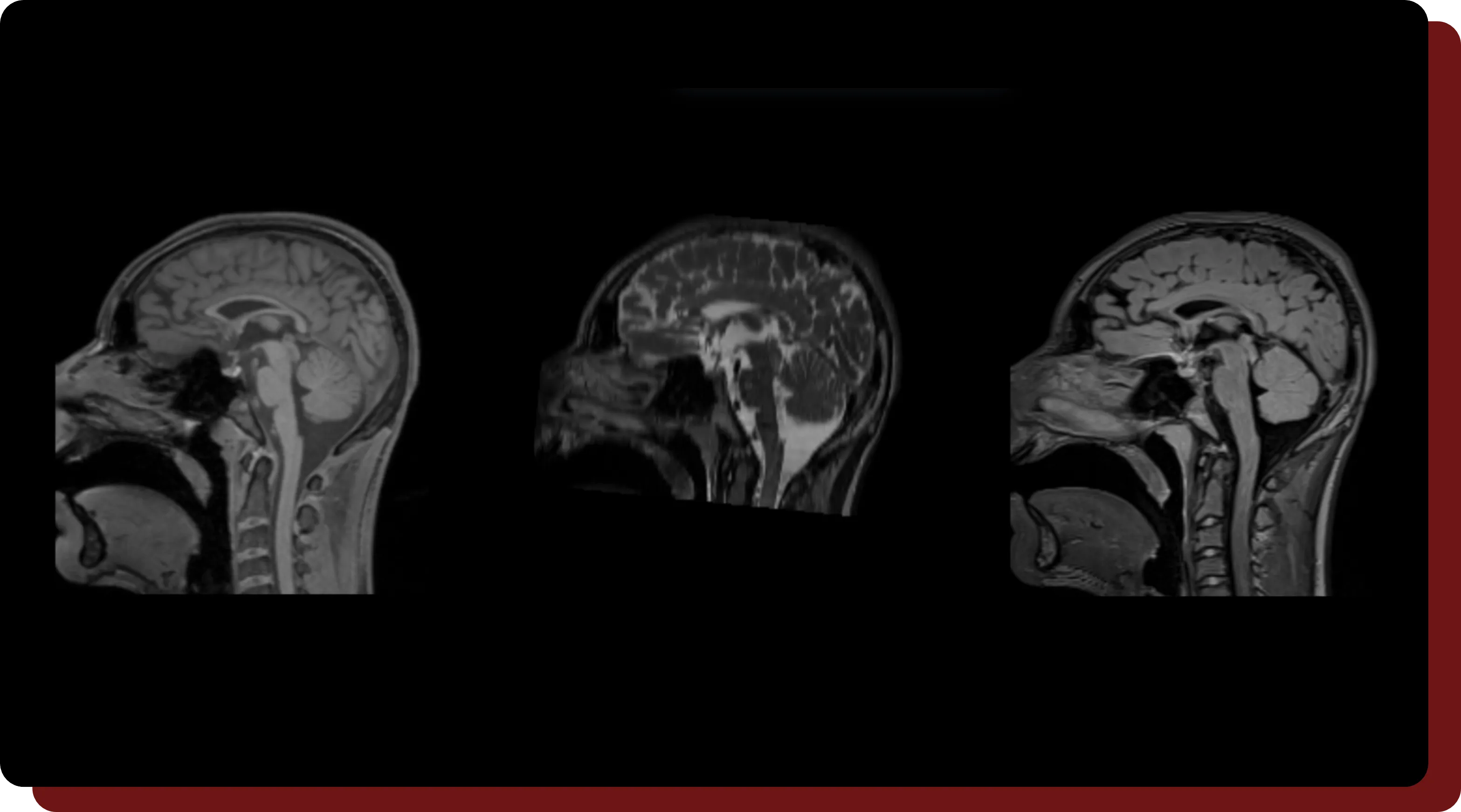 An example of the contrast support available in OncoAI - BrainTumor.