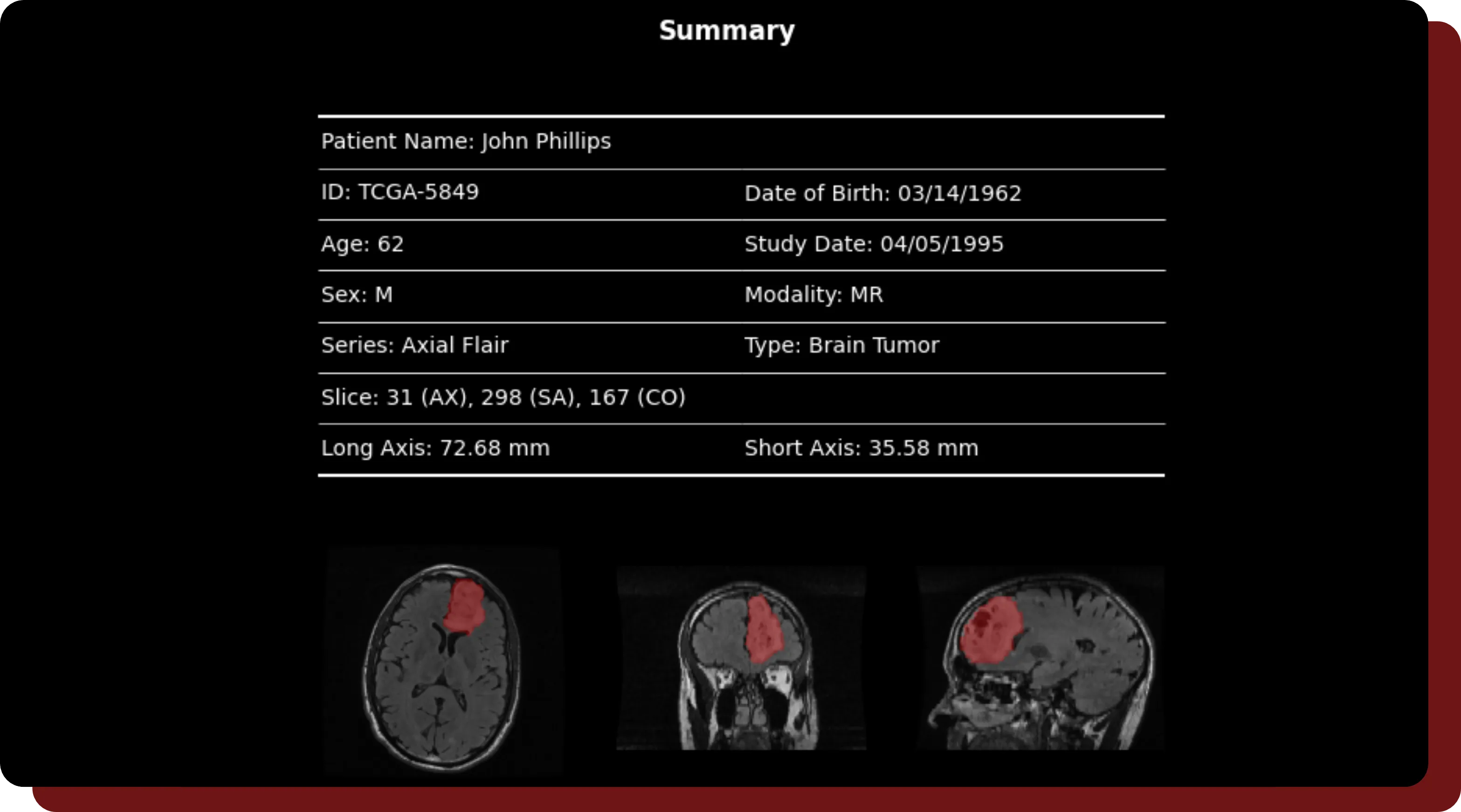 A sample generated report from an annotated study in OncoAI - BrainTumor.