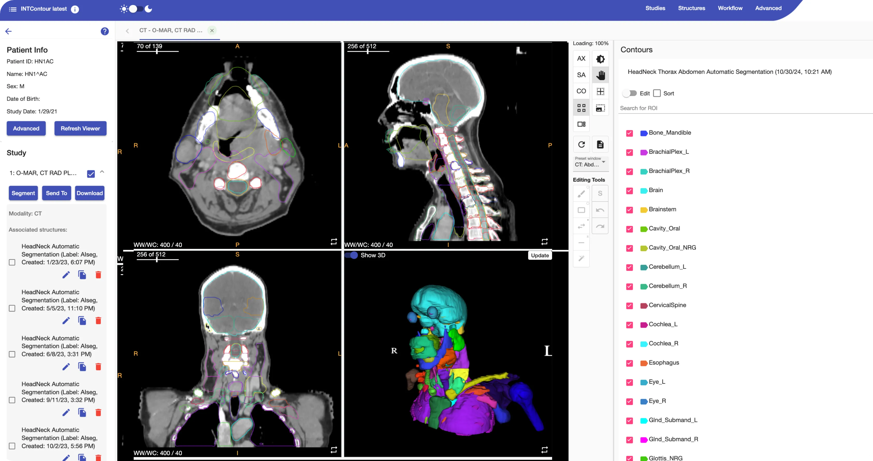 An example of an automated segmentation of a series within INTContour.