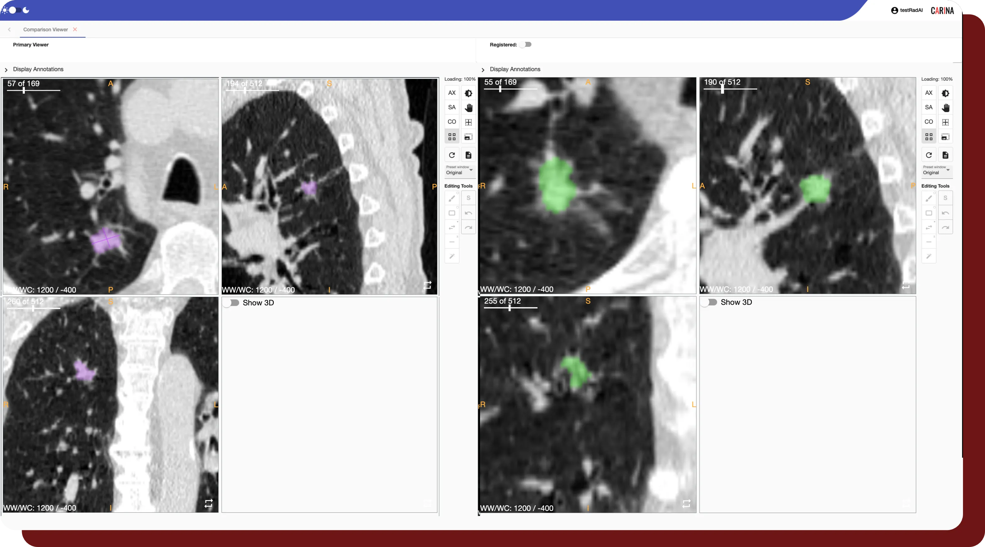 An example of two segmented series in OncoAI - LungNodule's Comparison Viewer. 