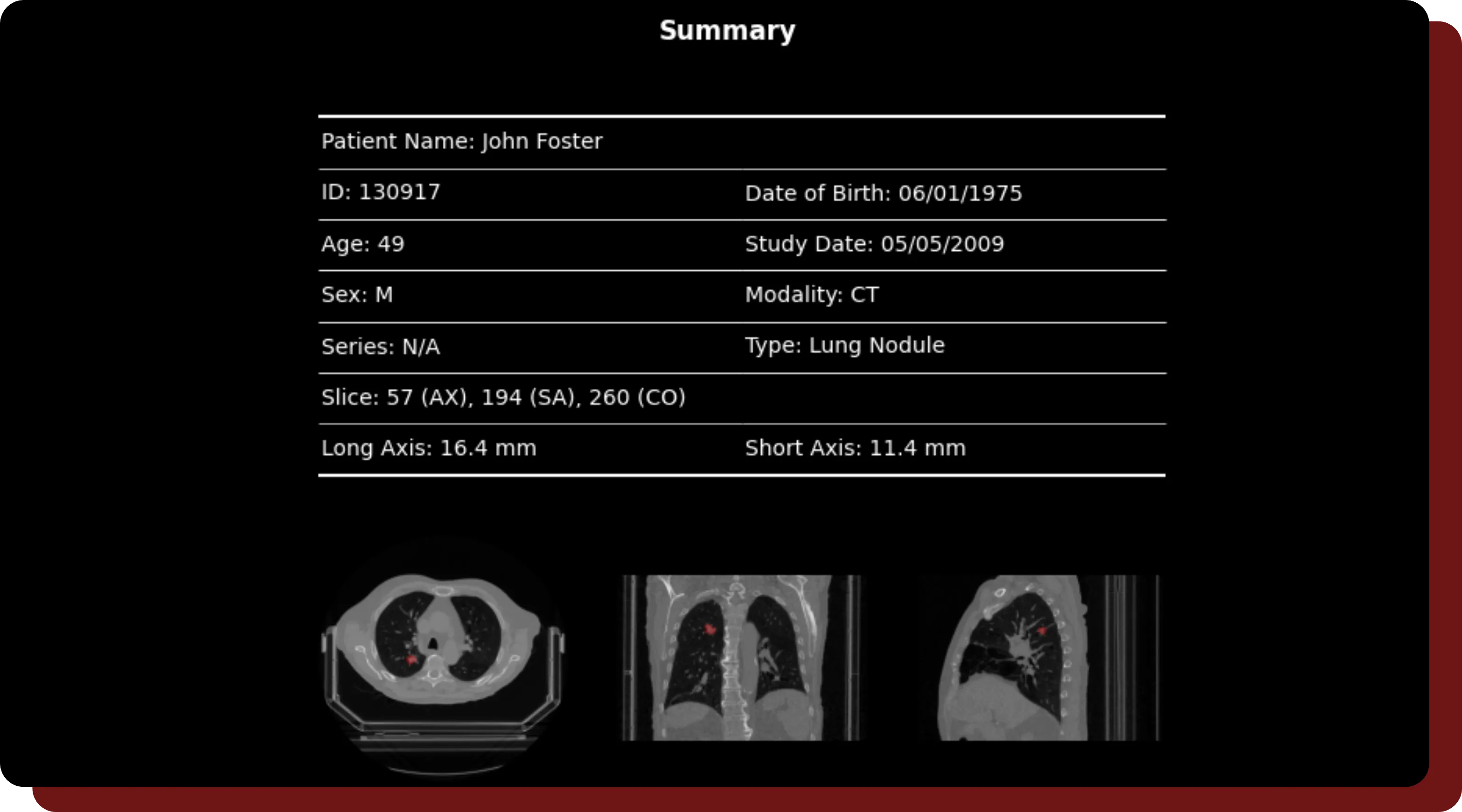 A sample generated report from an annotated study in OncoAI - LungNodule.