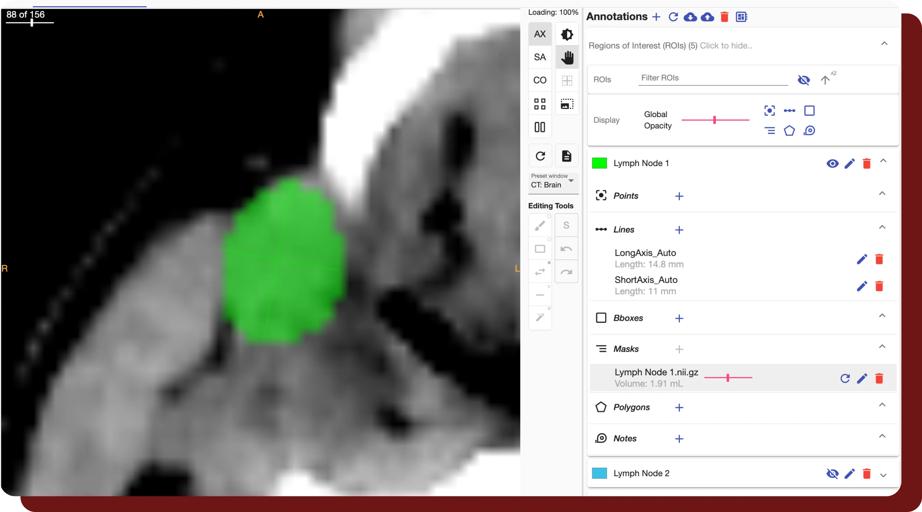 A study that has been segmented and is visible within OncoAI - LymphNode's viewer.