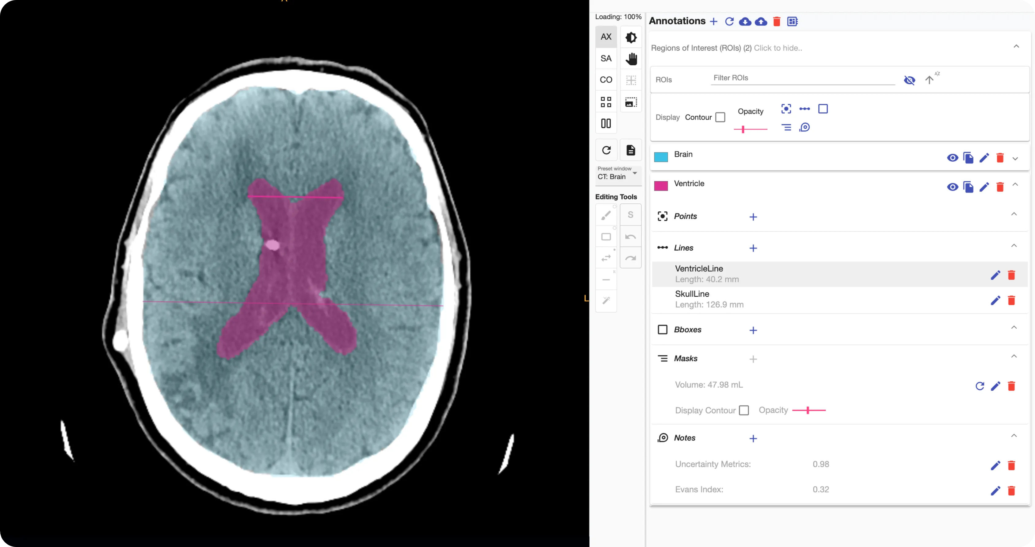 An example of an annotated ventricle within the study viewer of QuantBrain - Ventricle.