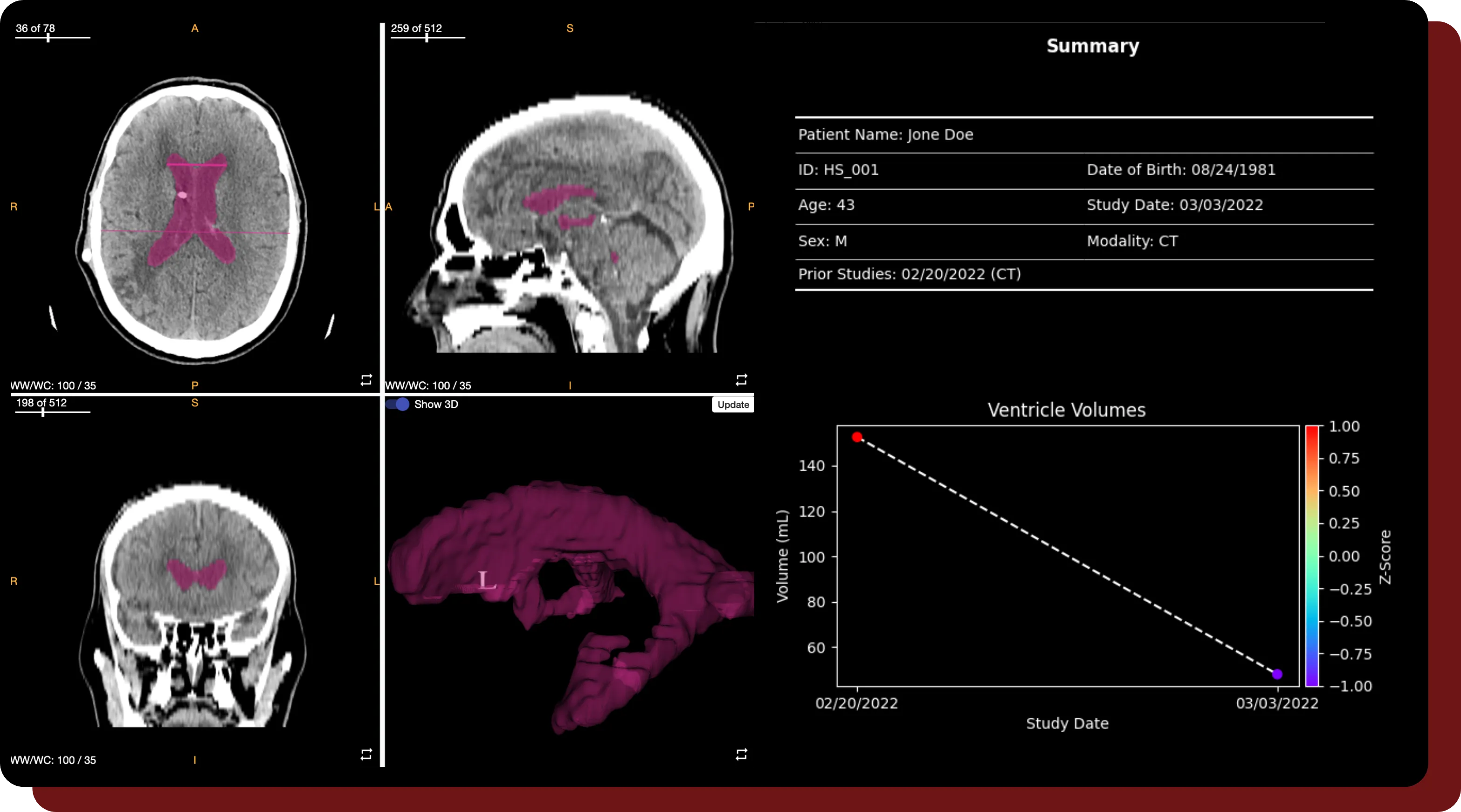 A sample generated report from a study annotated within QuantBrain - Ventricle.