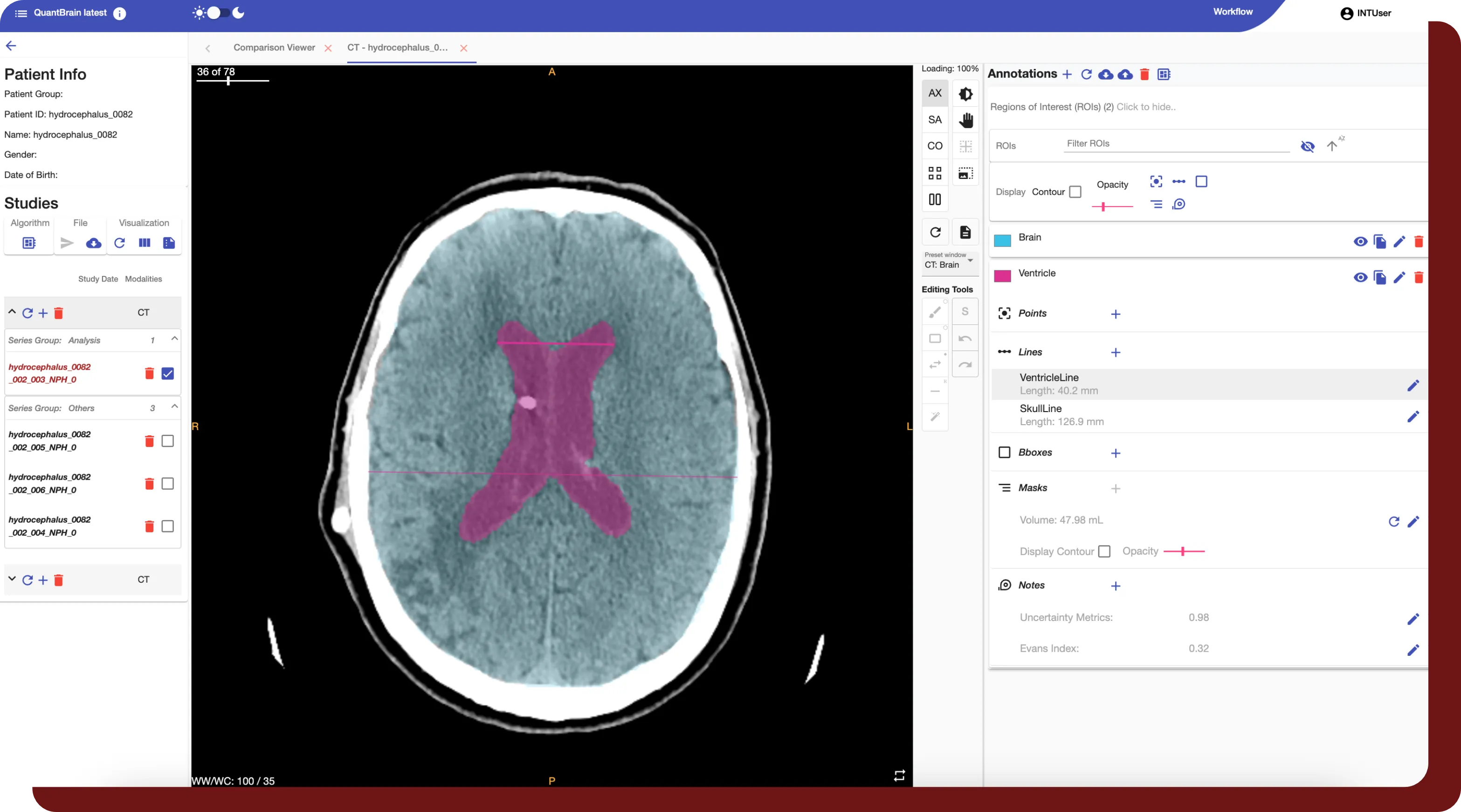 An example of a series with an annotated brain and ventricle within QuantBrain - Ventricle's built-in viewer.